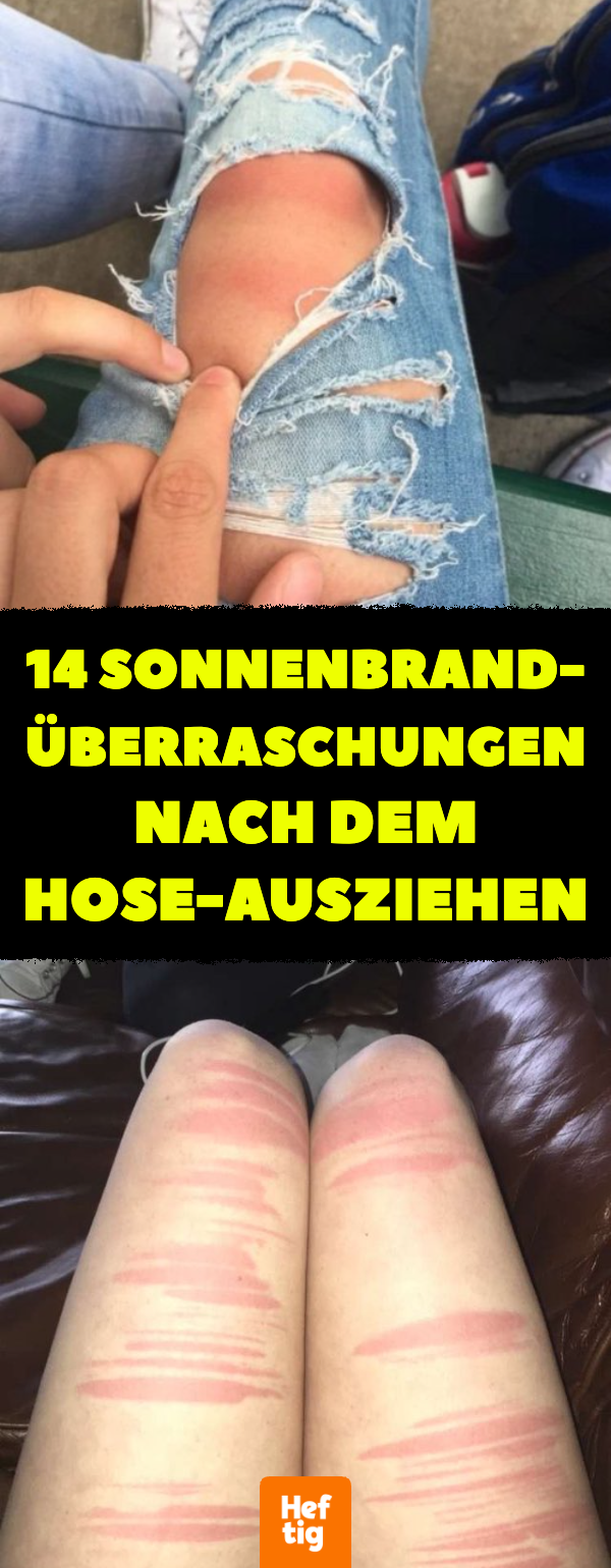 14 Sonnenbrand-Überraschungen nach dem Hose-Ausziehen