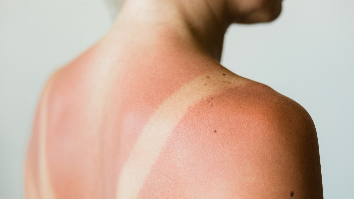 Nahaufnahme eines Sonnenbrandes auf dem Rücken einer Frau.