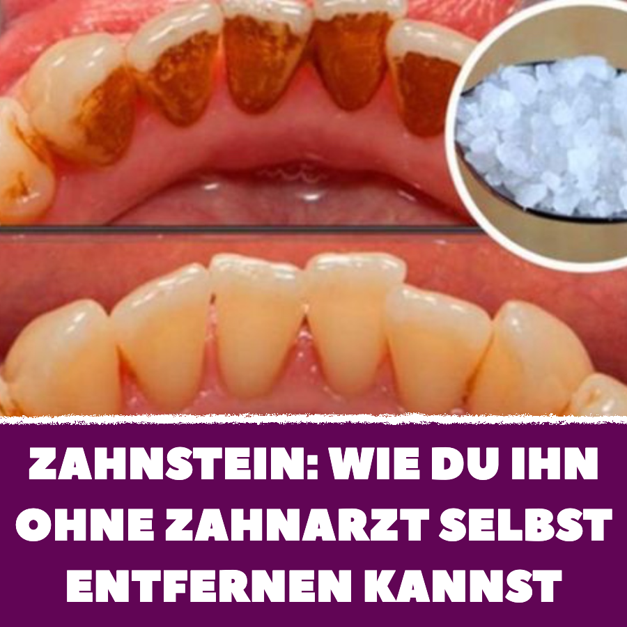 Zahnstein ohne Zahnarzt selbst entfernen: 4 Tipps