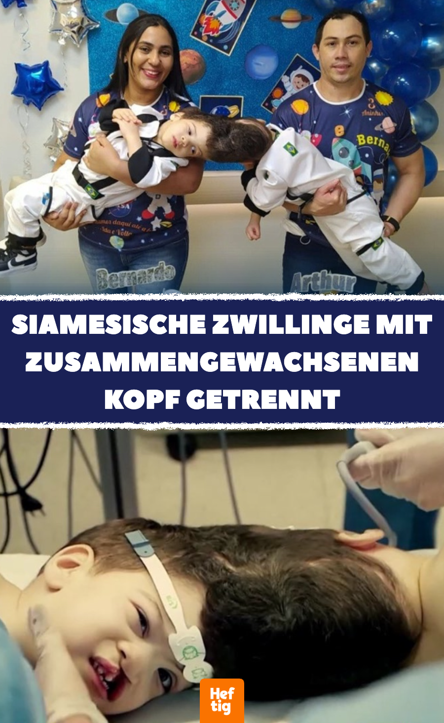 Siamesische Zwillinge mit zusammengewachsenen Köpfen getrennt