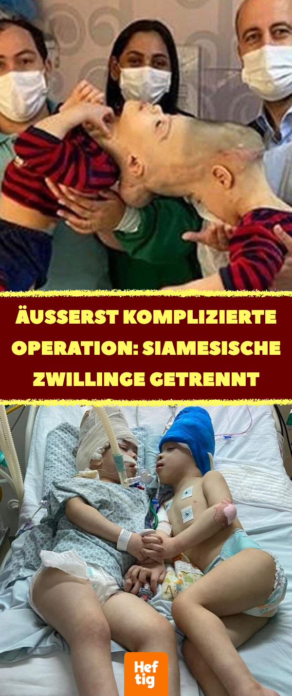 Siamesische Zwillinge mit zusammengewachsenen Köpfen getrennt